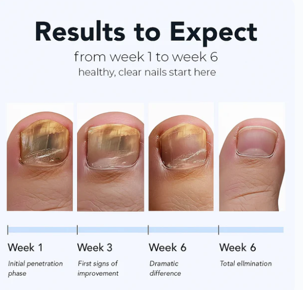 Nail fungus Removal Patches - Noyré